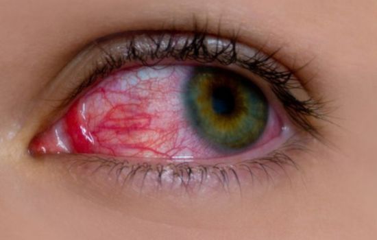 Glaucome
